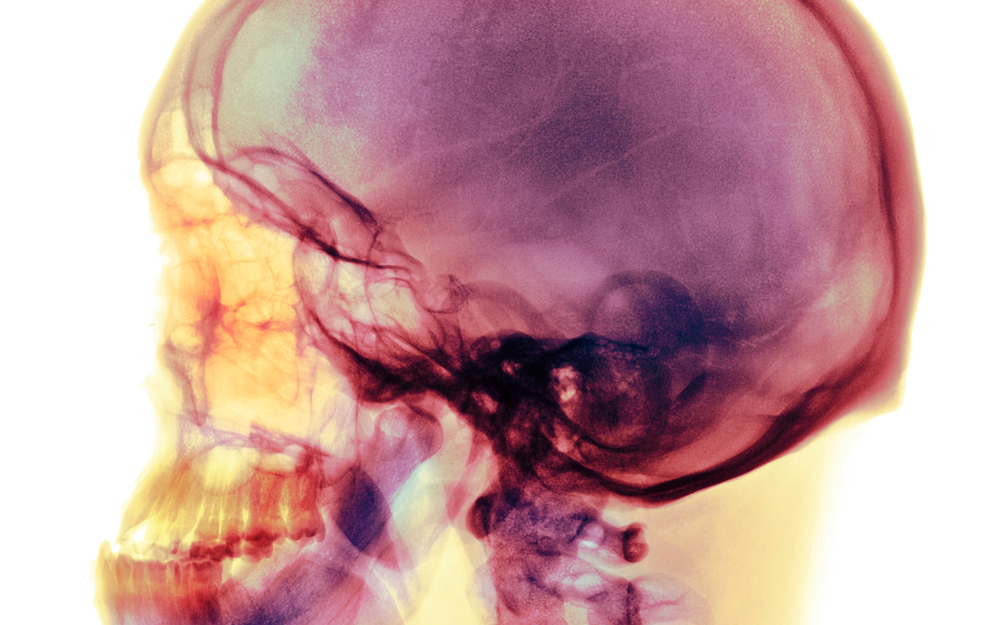 A colorized scan of a head and brain injury.